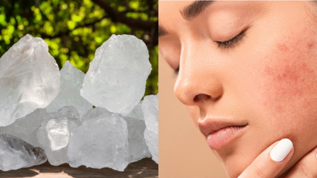 Mix these two ingredients in an alum stone and your acne will be gone by morning