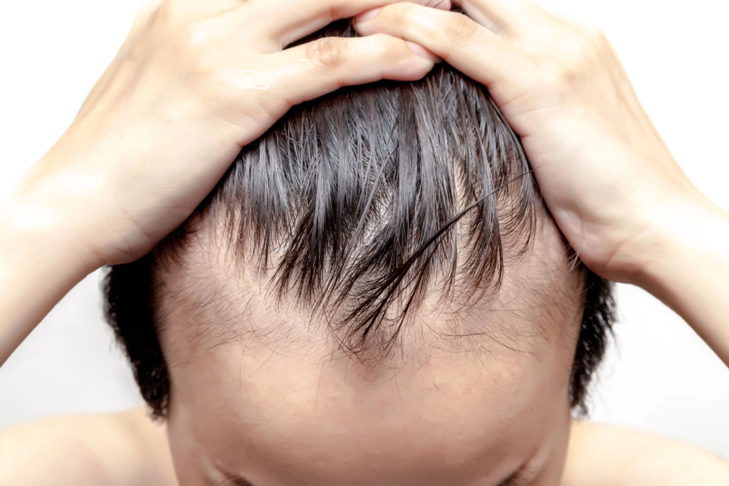 Reasons for early baldness
