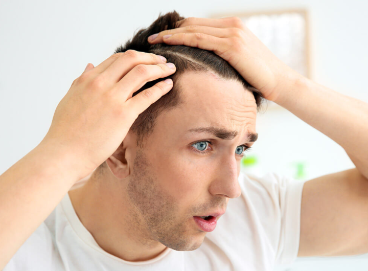 Reasons for early baldness